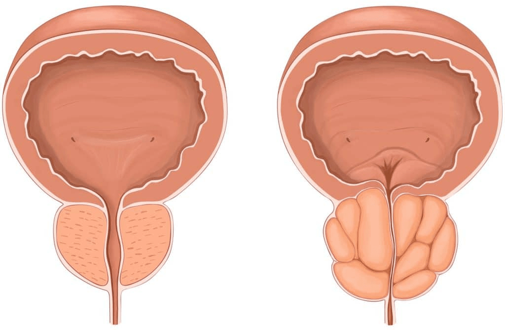 Čo sa stane s prostatou počas prostatitídy