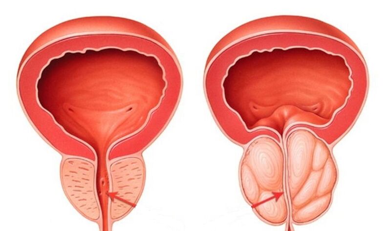 Zdravá a zapálená prostata s prostatitídou