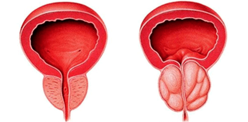 Normálna a zapálená prostata